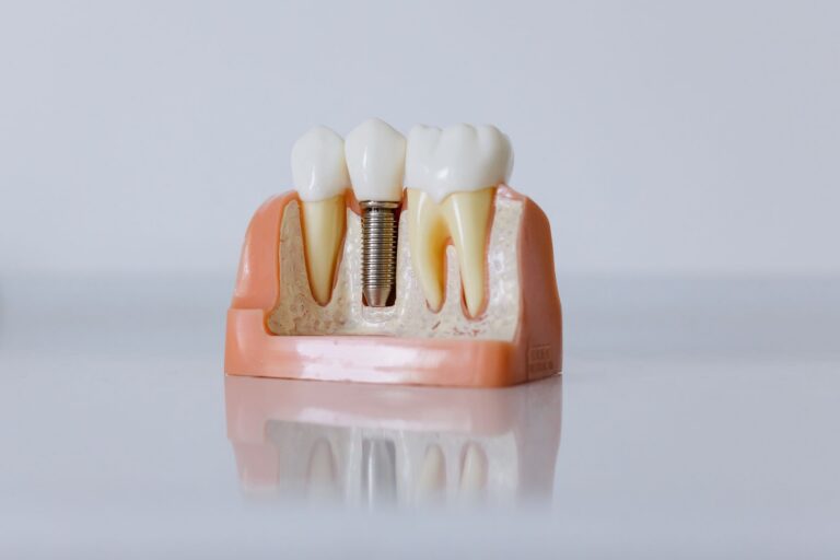Model demonstrativ de implant dentar cu bont și coroană, așezat pe o suprafață albă
