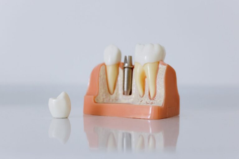 Cum se integrează implantul în os și de ce durează câteva luni Radiografie dentară pe un negatoscop, folosită pentru urmărirea vindecării osului din jurul unui implant