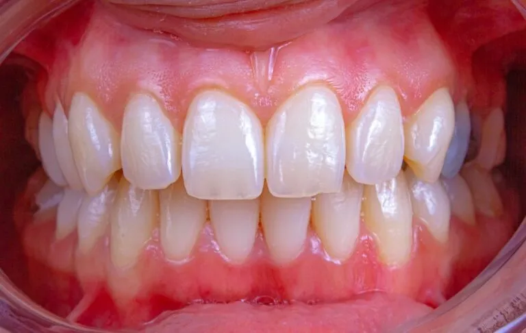 Photo gum preparation for crown aesthetics