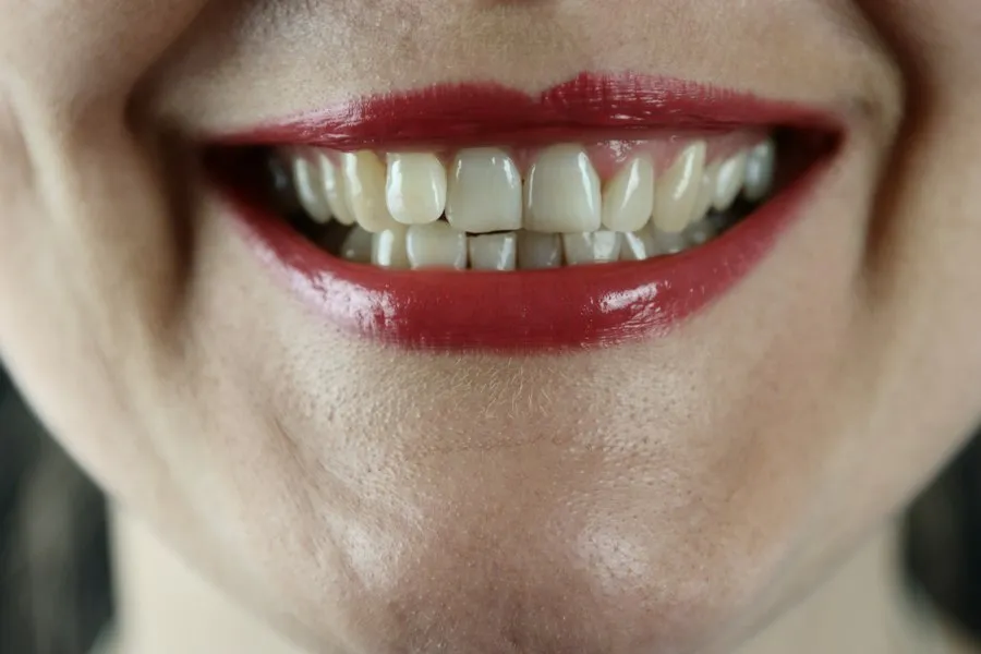 Photo teeth whitening guide