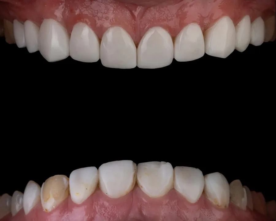 teeth whitening guide