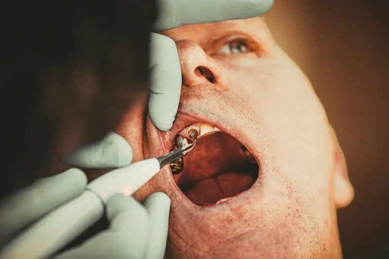 Etapele unui implant: analiză aprofundată și recomandări bazate pe cercetare Photo dental implant procedure steps research-based recommendations